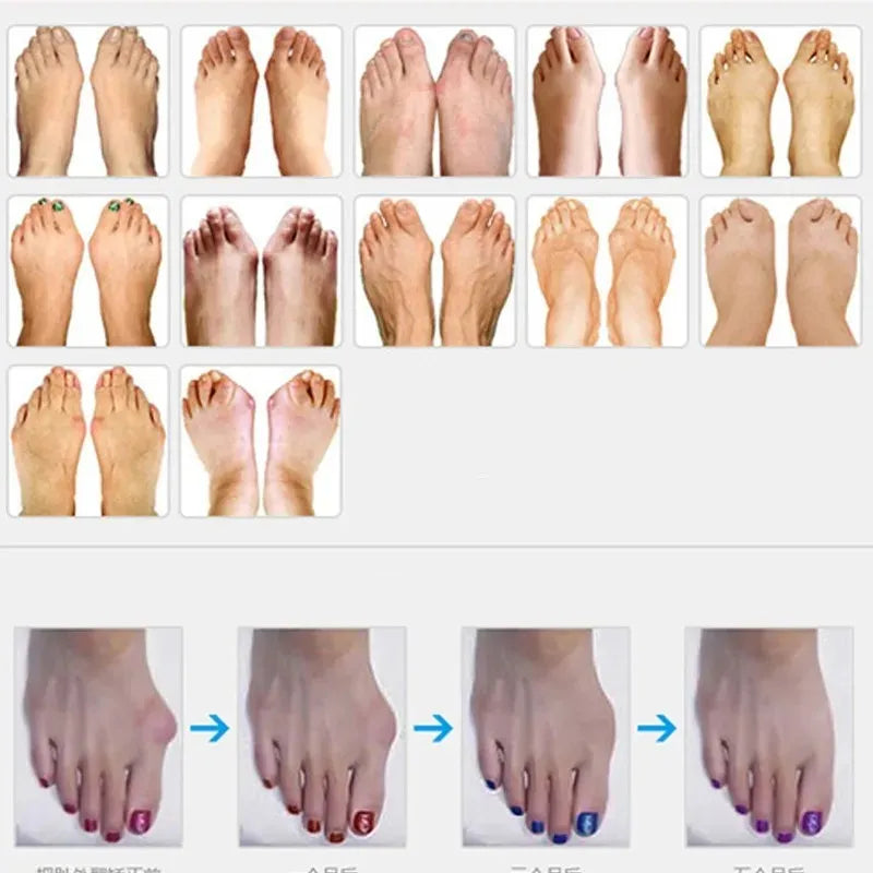 Pinky Toe Separator, Gel Little Toe Protector for Foot Care & Pedicure Support-TRUZENIC