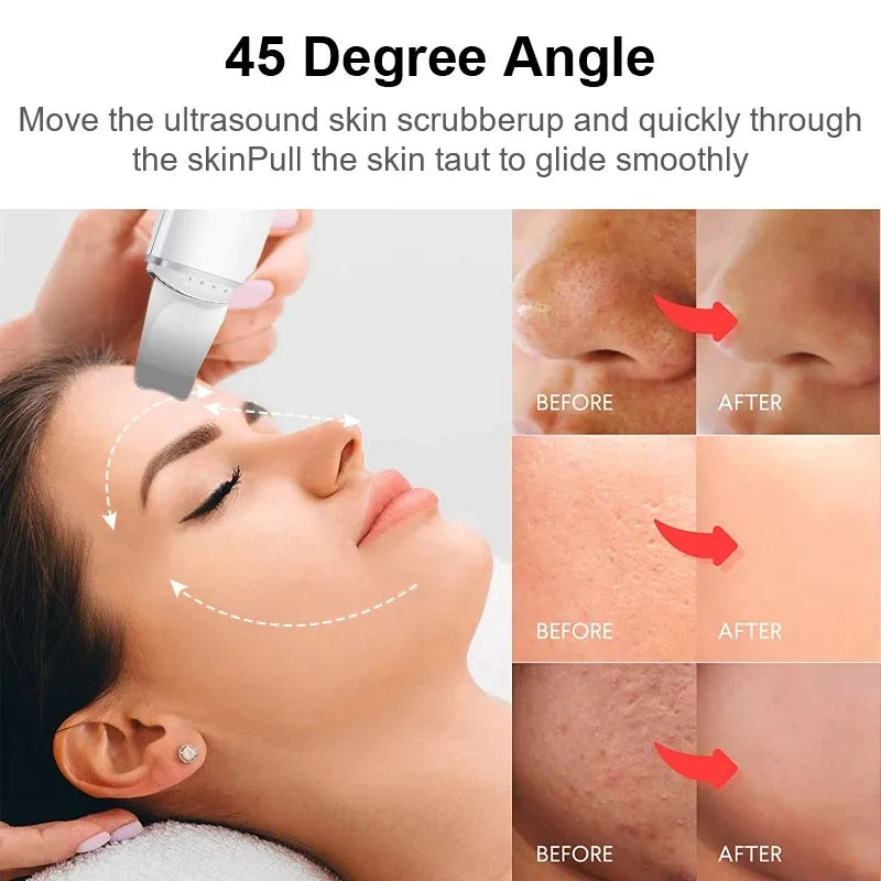 Ultrasonic Skin Scrubber, Vibration Face Spatula & Blackhead Remover for Deep Pore Cleansing, Peeling & Facial Lifting-TRUZENIC