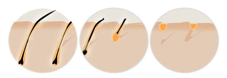 TRUZENIC At-Home IPL Laser Hair Removal Device