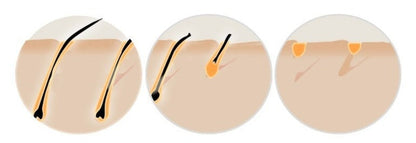 TRUZENIC At-Home IPL Laser Hair Removal Device