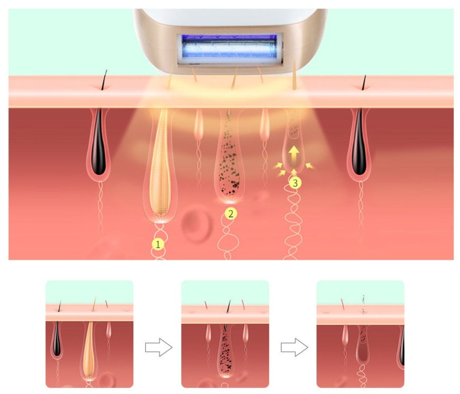 TRUZENIC IPL Laser Hair Removal Device