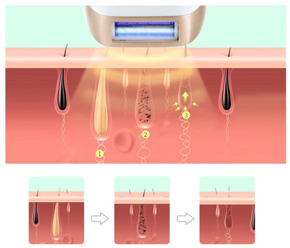 TRUZENIC IPL Laser Hair Removal Device